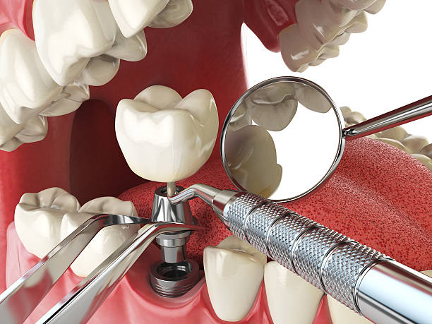 Best Emergency Tooth Extraction in Houserville, PA